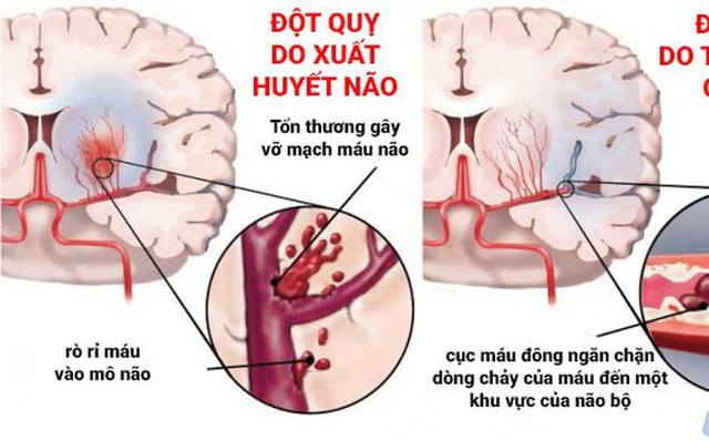  Đột quỵ não ở Việt Nam đang ở mức báo động đỏ: Chuyên gia gửi 5 câu hỏi để người trẻ kiểm tra lối sống - Ảnh 1.