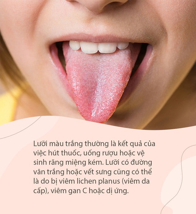 Người trẻ tuổi hiện đại thường không thể sống thiếu cà phê, nhưng nếu thấy dấu hiệu này xuất hiện ở lưỡi thì cần phải hạn chế sử dụng ngay - Ảnh 4.