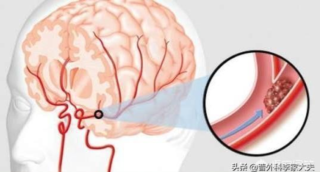 Khi ngủ mà gặp 4 biểu hiện này trên cơ thể thì cần đi khám, nếu chủ quan để nặng có thể dẫn đến nhồi máu não hay tai biến mạch máu não - Ảnh 4.