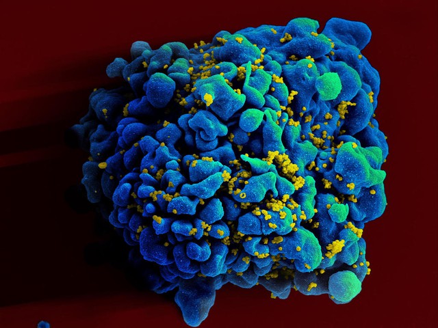 Bệnh nhân đầu tiên trên thế giới khỏi HIV mà không cần điều trị - Ảnh 3.
