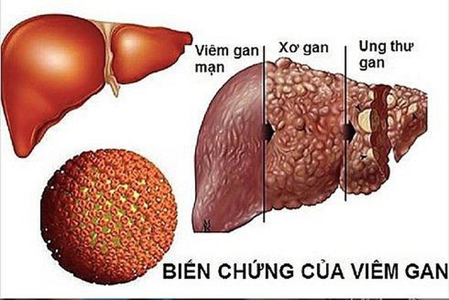 Ung thư biểu mô tế bào gan chiếm 80% các trường hợp, thường liên quan đến các tổn thương gan mạn tính: Bệnh tiến triển vô cùng nhanh, ai cũng phải hành động ngay điều này để giảm rủi ro chết người - Ảnh 1.