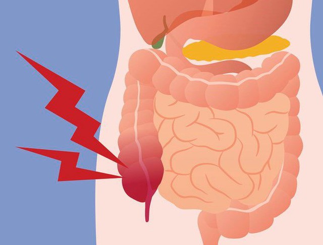 Bệnh lý viêm ruột thừa sợ nhất hai từ “quá muộn”: Bác sĩ BV Việt Đức cảnh báo những phản xạ cần có khi đau bụng để bảo toàn tính mạng - Ảnh 2.