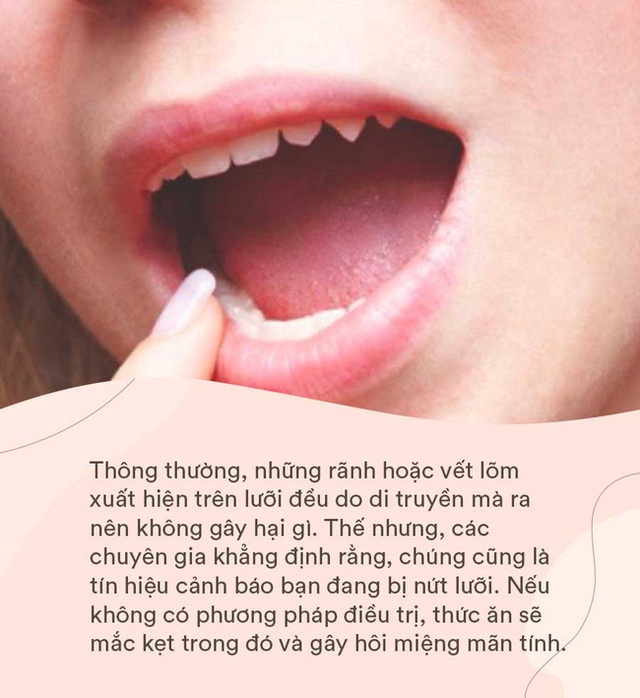 Lưỡi không chỉ giúp bạn nói mà ngay cả các loại bệnh nguy hiểm nó cũng “lên tiếng” được thông qua 5 dấu hiệu - Ảnh 3.