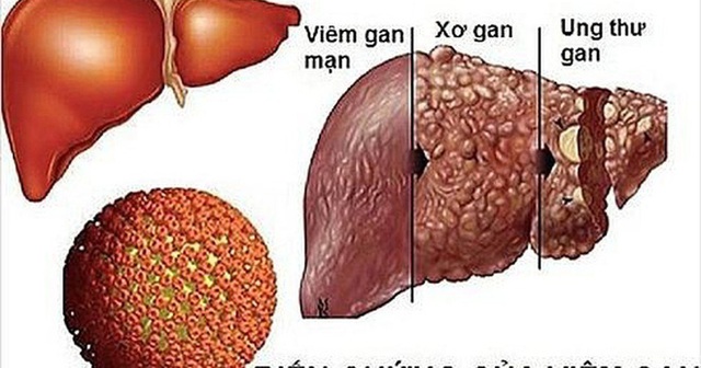 Căn bệnh ung thư là nỗi ám ảnh của bác sĩ, rất phổ biến ở Việt Nam: 5 cách phòng bệnh cần làm ngay - Ảnh 2.