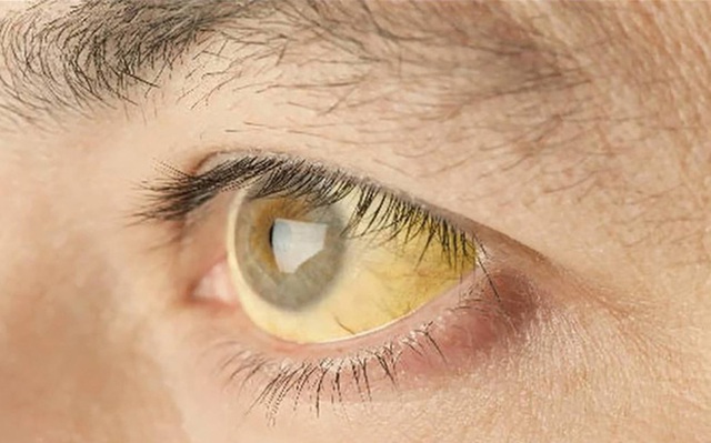 2 dấu hiệu bất thường ở mắt sẽ giúp bạn phán đoán nguy cơ ung thư từ giai đoạn đầu