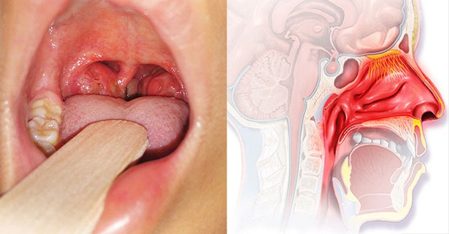 Sự thật về nạo VA gây suy giảm miễn dịch cho trẻ: Chuyên gia nói gì? - Ảnh 1.