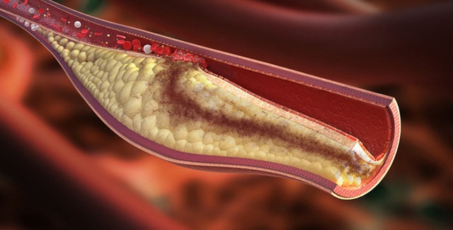 Cholesterol cao là nguyên nhân gây bệnh tim mạch và đột quỵ sớm: Cần nắm 5 cách để xử lý nhanh gọn chỉ trong thời gian ngắn - Ảnh 1.