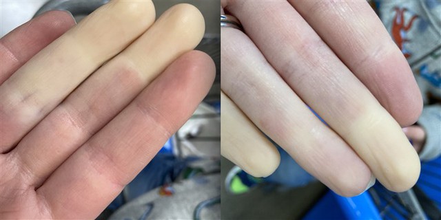 Căn bệnh lạ khiến tay chân “bay màu” khi trời lạnh là có thật! - Ảnh 3. Căn bệnh lạ khiến tay chân “bay màu” khi trời lạnh là có thật! - Ảnh 3.
