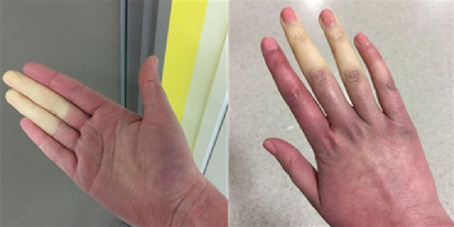 Căn bệnh lạ khiến tay chân “bay màu” khi trời lạnh là có thật! - Ảnh 2. Căn bệnh lạ khiến tay chân “bay màu” khi trời lạnh là có thật! - Ảnh 2.