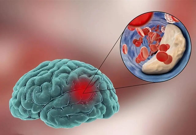 Nhồi máu não rất “sủng ái” 4 kiểu người này: Muốn não ưu ái chỉ cần duy trì 3 thói quen tốt, quái vật não cũng sợ hãi mà tránh xa  - Ảnh 1.