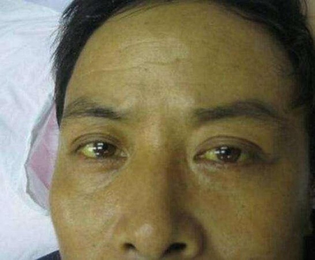 3 biểu hiện bất thường ở mắt cho thấy có thể gan đang bị bệnh - Ảnh 1.
