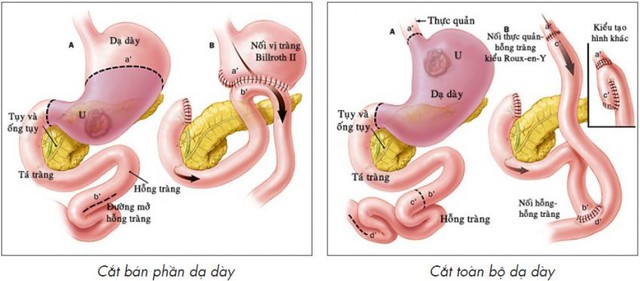 Căn bệnh khiến ca sĩ Minh Quân phải cắt bỏ 80% dạ dày nguy hiểm ra sao? Đáng nói, hàng triệu người chủ quan khiến bệnh từ lành tính chuyển sang biến chứng ung thư - Ảnh 1.