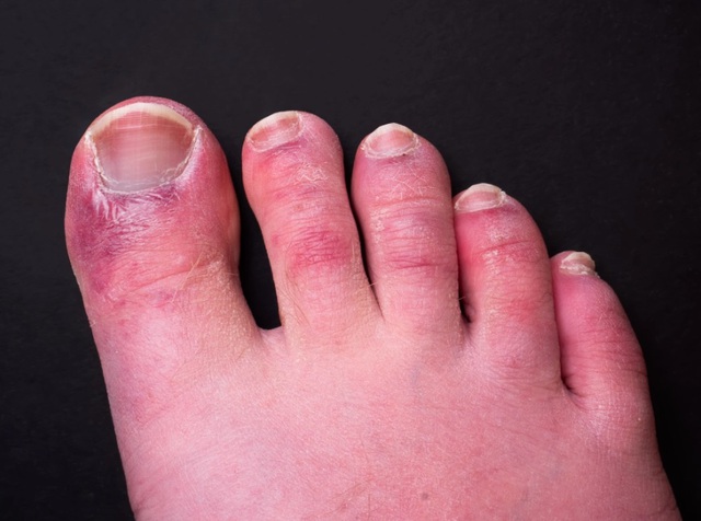 Triệu chứng Covid-19 đáng sợ ở chân: Chuyên gia vạch mặt thủ phạm gây ra ‘ngón chân Covid’ - Ảnh 1.