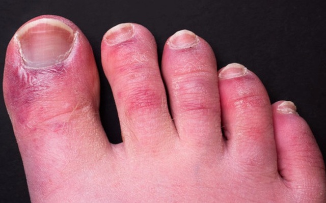 Triệu chứng Covid-19 đáng sợ ở chân: Chuyên gia 'vạch mặt' thủ phạm gây ra ‘ngón chân Covid’