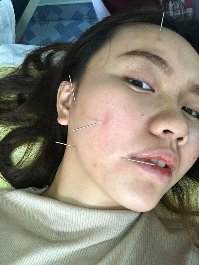 Cô gái 26 tuổi bị liệt dây thần kinh số 7 khiến nửa mặt phải cứng đơ chỉ vì thói quen tai hại mà nhiều người trẻ hay mắc phải - Ảnh 4.