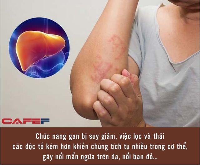 Cơ thể phát ra 2 ngứa và 3 đen, biểu hiện sức khỏe gan đang cực kỳ kém, tốt nhất đừng dính phải dù chỉ 1 đặc điểm - Ảnh 1.