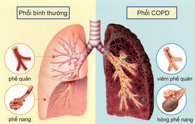 Khoảng 3 triệu người tử vong mỗi năm vì căn bệnh này ở phổi, có 6 dấu hiệu nhận biết khi bệnh mới khởi phát, đáng tiếc nhiều người lại hay bỏ qua - Ảnh 1.