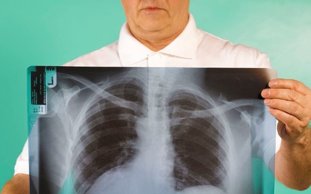Viêm phổi sẽ gây ra rất nhiều ảnh hưởng nghiêm trọng tới sức khỏe. Ảnh: Aboluowang