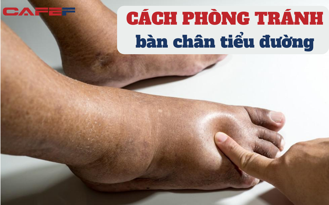 Biến chứng tiểu đường gây hoại tử, thậm chí mất ngón chân: Bác sĩ lưu ý NÊN và KHÔNG NÊN khi chăm sóc "bàn chân tiểu đường", bỏ túi ngay kẻo hối hận