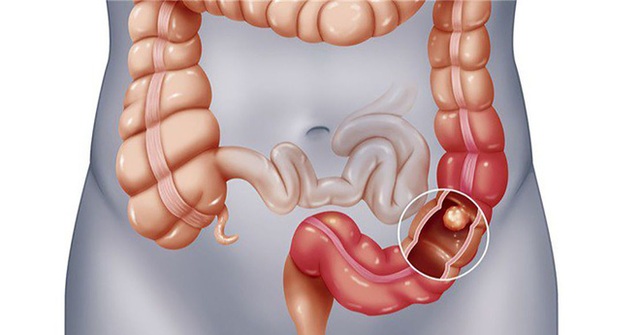 Dự đoán nguy cơ ung thư đại trực tràng: Nam nhìn vào chỉ số BMI, nữ nhìn vào tỷ lệ eo/hông - Ảnh 1.