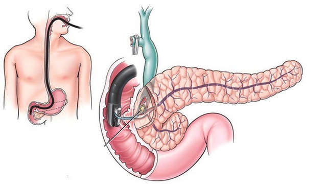 Căn bệnh ung thư có tỉ lệ mắc bệnh và tử vong cao bằng nhau: Cơ hội sống chỉ dài 4-7 tháng - Ảnh 2.