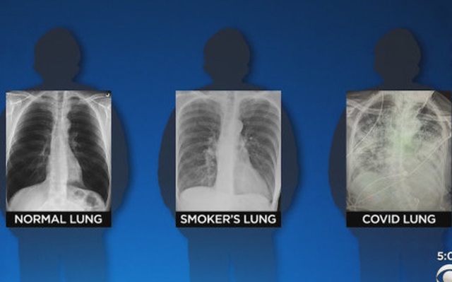 BS so sánh 3 lá phổi: Bệnh nhân Covid-19 có hậu quả tổn thương nghiêm trọng hơn, bị sẹo phổi