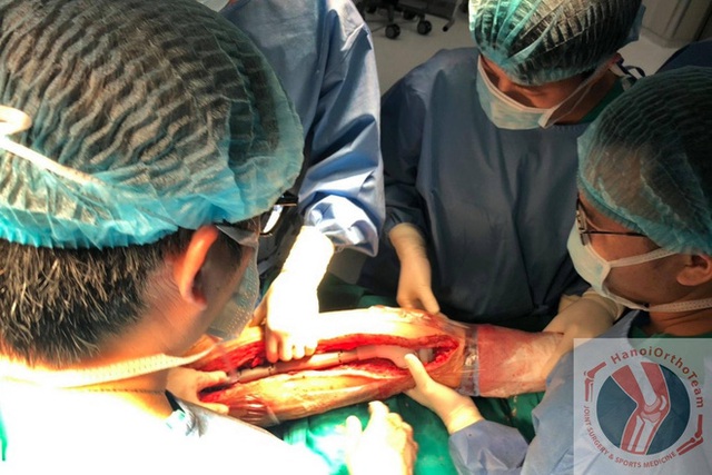 Ca phẫu thuật thay xương đùi cho bệnh nhân nhỏ tuổi nhất Việt Nam, thứ 2 thế giới - Ảnh 3.