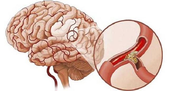 Sau 40 tuổi, cơ thể có 4 thay đổi này thì tốt nhất nên đi kiểm tra não - Ảnh 1.