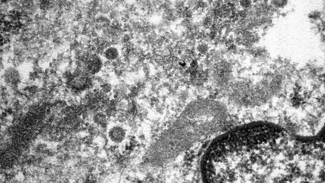 Bác sĩ công bố hình ảnh phiên bản đời thực của virus SARS-CoV-2 chụp từ tế bào bệnh nhân - Ảnh 2.