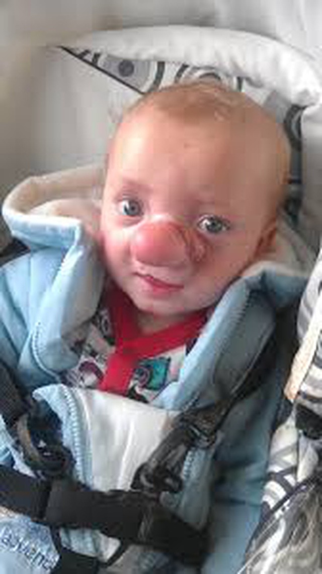 Cậu bé Pinocchio đời thực” sinh ra với chiếc mũi to dị dạng khiến bố mẹ cũng sốc, gây bất ngờ với diện mạo sau ít năm - Ảnh 5.