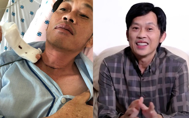 NÓNG: Nghệ sĩ Hoài Linh phẫu thuật vì bị u ác tuyến giáp cách đây vài tháng