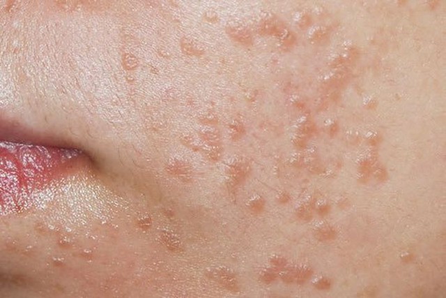 Bé gái 7 tuổi bị nhiễm virus HPV, cảnh báo về thói quen dùng chung đồ vật trong nhà - Ảnh 1.