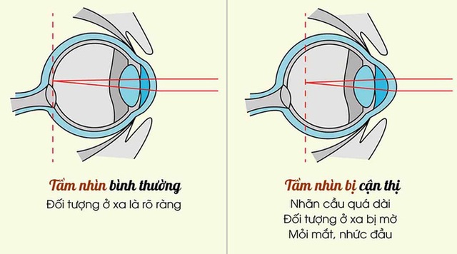 Sốc với lý do khiến tỉ lệ trẻ bị cận thị tăng phi mã: Cách ăn uống đã tiếp tay tàn phá thị lực - Ảnh 3.