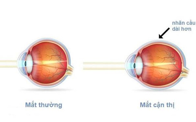 Sốc với lý do khiến tỉ lệ trẻ bị cận thị tăng "phi mã": Cách ăn uống đã "tiếp tay" tàn phá thị lực