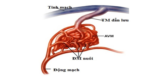 Bé gái 10 tuổi đã bị dị dạng động tĩnh mạch, phải chuyển tới Trung tâm Đột quỵ cấp cứu: Cảnh báo căn bệnh nguy hiểm - Ảnh 3.