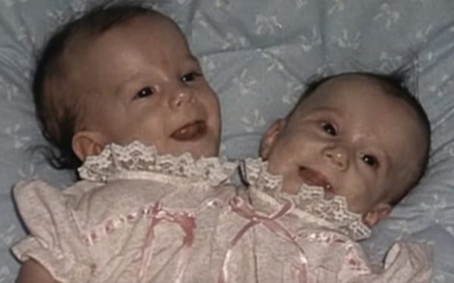 Bị chẩn đoán khó sống sót, cặp chị em sinh đôi dính liền chỉ có 2 chân khiến thế giới kinh ngạc với cuộc sống và diện mạo sau hơn 30 năm