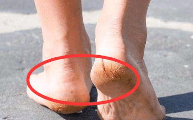 Bác sĩ nhắc nhở: Nếu bàn chân có "tín hiệu" này thì 80% ung thư gan đã xuất hiện, cần nhanh chóng kiểm tra