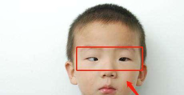 Bé trai 5 tuổi mắt thâm đen, con ngươi 1 bên mắt biến mất, bị lác nghiêm trọng bởi thói quen dễ dãi của nhiều bố mẹ trẻ - Ảnh 2.