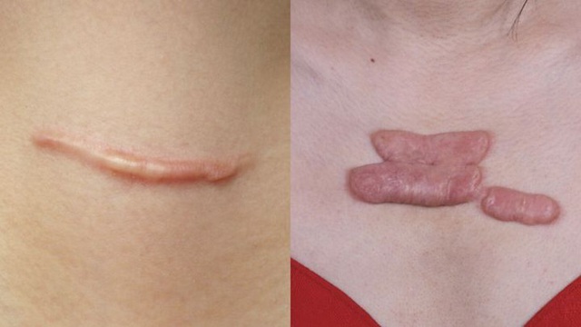  Một vết sẹo của người phụ nữ đã phát triển thành ung thư, Bác sĩ nhắc nhở: 3 loại sẹo trên cơ thể cần được điều trị nhanh chóng  - Ảnh 3.