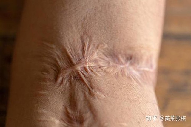  Một vết sẹo của người phụ nữ đã phát triển thành ung thư, Bác sĩ nhắc nhở: 3 loại sẹo trên cơ thể cần được điều trị nhanh chóng  - Ảnh 4.