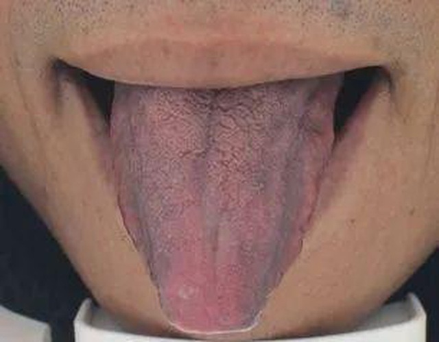3 hình dạng bất thường của lưỡi cho thấy có thể bệnh tuyến giáp đang âm thầm phát triển trong cơ thể, cần đi khám ngay - Ảnh 1.