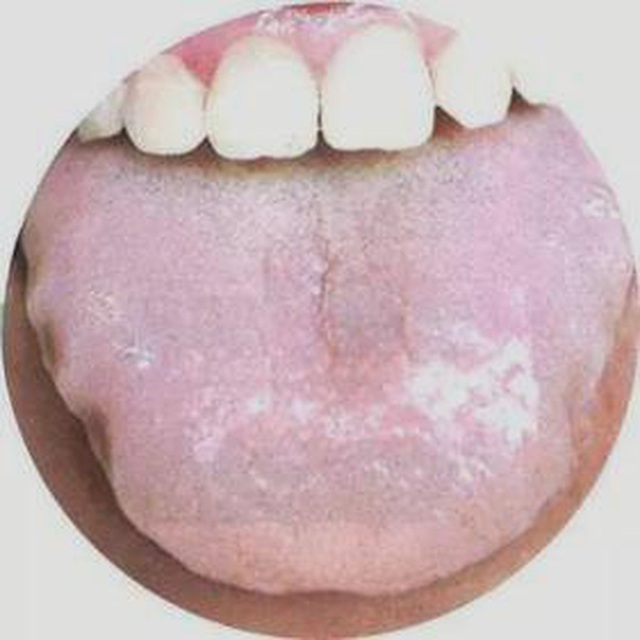 3 hình dạng bất thường của lưỡi cho thấy có thể bệnh tuyến giáp đang âm thầm phát triển trong cơ thể, cần đi khám ngay - Ảnh 2.