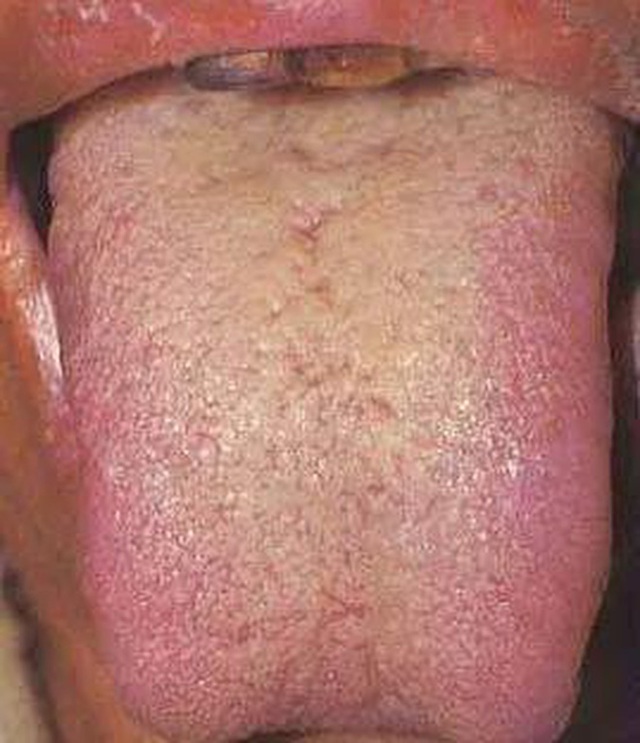 3 hình dạng bất thường của lưỡi cho thấy có thể bệnh tuyến giáp đang âm thầm phát triển trong cơ thể, cần đi khám ngay - Ảnh 3.