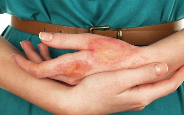 7 dấu hiệu bất thường trên da cho thấy đường huyết đang tăng cao, hãy can thiệp khẩn cấp để tránh các biến chứng nguy hiểm - Ảnh 4.