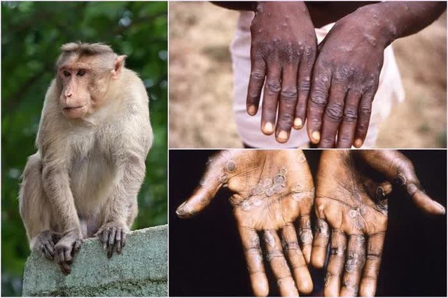 Thấy da nổi những nốt phát ban thế này, cần cảnh giác với bệnh đậu mùa khỉ - Ảnh 3.