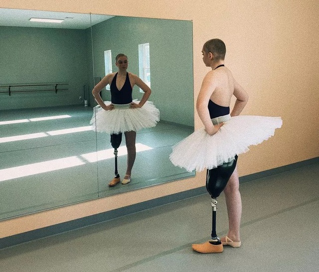  Xúc động trước nghị lực sống của nữ vũ công 21 tuổi mắc ung thư xương - Ảnh 2.