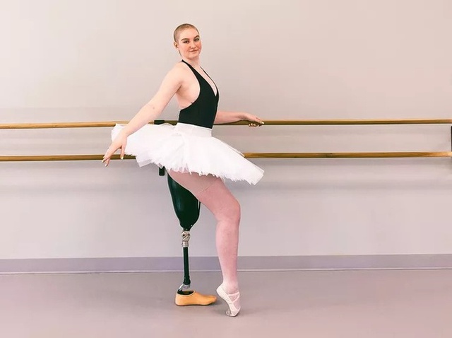  Xúc động trước nghị lực sống của nữ vũ công 21 tuổi mắc ung thư xương - Ảnh 1.