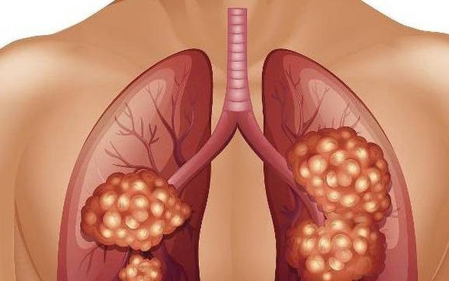 Ung thư phổi không ‘ngụy trang’ cũng không ‘tàng hình’: 1 THÔ, 1 TÊ, 1 ĐAU cảnh báo bệnh đang âm thầm tấn công cơ thể, dù chỉ có 1 biểu hiện cũng cần khám ngay