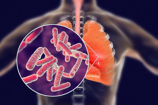 5 dấu hiệu gần như chắc chắn phổi đã bị căn bệnh khiến 1,5 triệu người mất mạng năm 2020 tấn công: Bác sĩ cảnh báo đến viện sớm, bệnh trở nặng mất mạng như chơi - Ảnh 2.