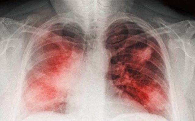 3 dấu hiệu vào ban đêm chứng tỏ phổi đã bị tổn thương. Ảnh: Sohu